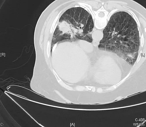 What is Pulmonary Embolectomy: Overview, Benefits, and Expected Results