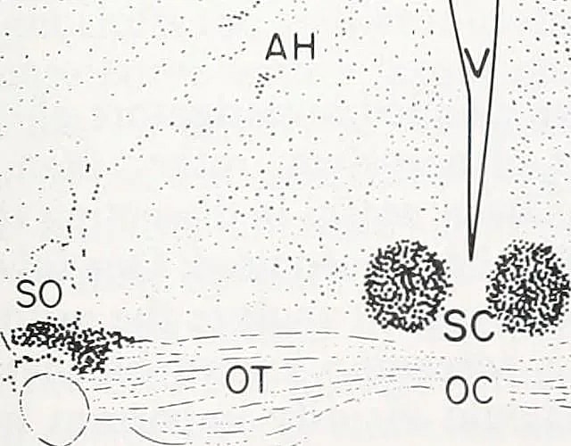 What is Pinealectomy: Overview, Benefits, and Expected Results