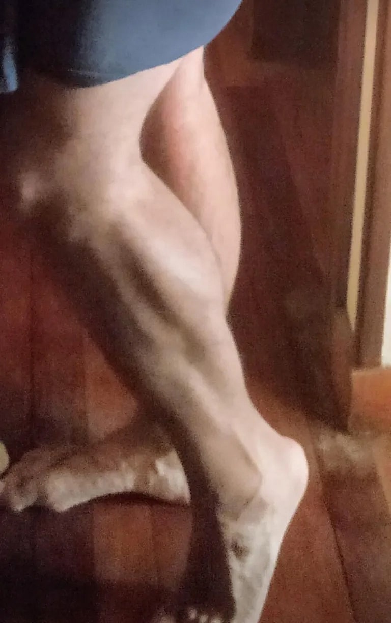 What is Phalloplasty: Overview, Benefits, and Expected Results