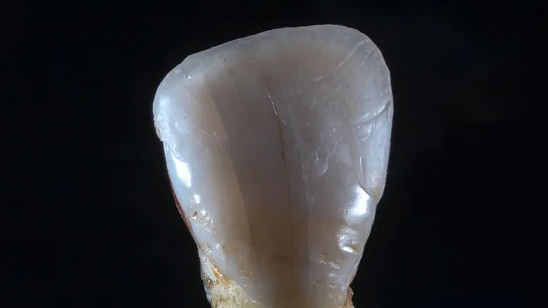 What is Prosthesis: Overview, Benefits, and Expected Results