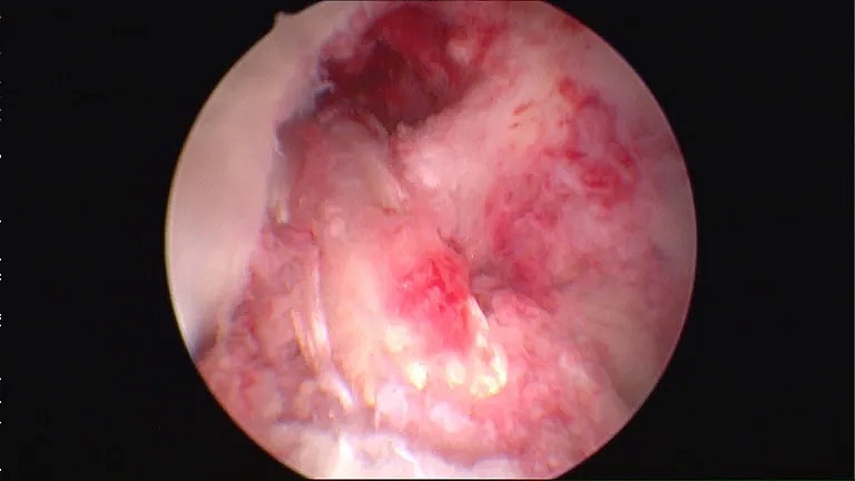 What is Posterior Cruciate Ligament Reconstruction: Overview, Benefits, and Expected Results