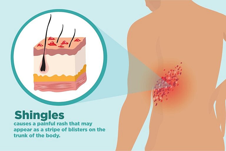 Signs of Shingles Herpes Zoster, Signes de zona Herpes Zoster, القوباء المنطقية