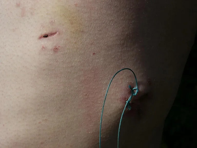 What is Pleurodesis: Overview, Benefits, and Expected Results