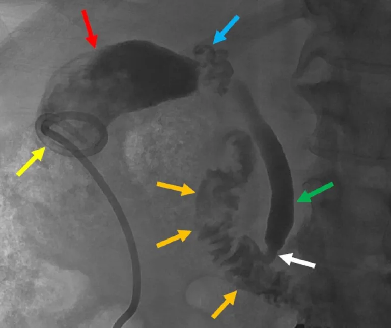 What is Percutaneous Skeletal Fixation: Overview, Benefits, and Expected Results