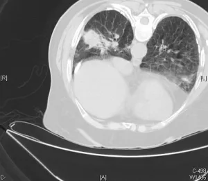 Qu'est-ce que l'embolectomie pulmonaire : aperçu, avantages et résultats attendus