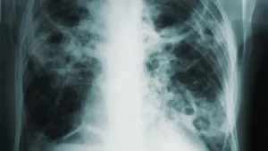 Qu'est-ce que l'endartériectomie pulmonaire avec ou sans pontage cardiopulmonaire : aperçu, avantages et résultats attendus