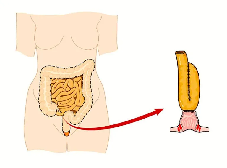 What is Proctocolectomy: Overview, Benefits, and Expected Results