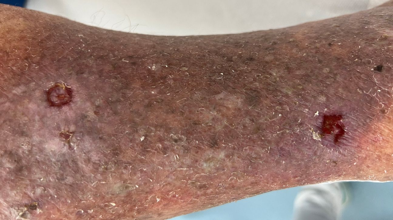 skin discoloration and ulcers on leg
