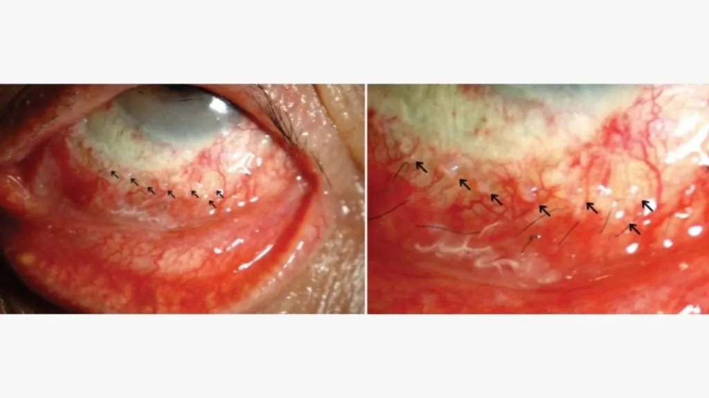 Sebaceous Carcinoma: Symptoms, Photos, Staging, Treatment image 13