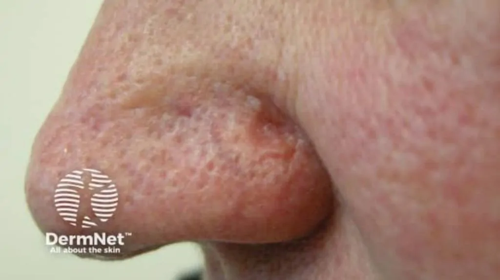 Sebaceous Carcinoma: Symptoms, Photos, Staging, Treatment image 14